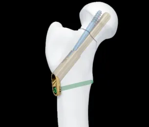 FNS- FEMORAL NECK SYSTEM