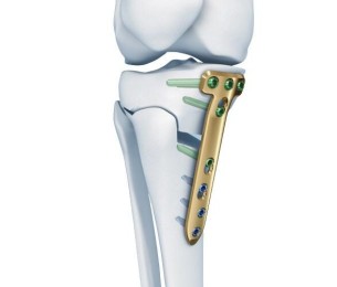 TOMOFIX OSTEOTOMY SYSTEM
