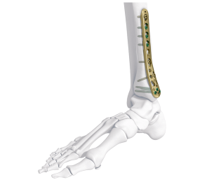 VA-LCP ANKLE PLATE
