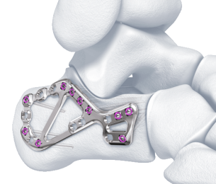VA-LCP CALCANEAL LOCKING PLATE