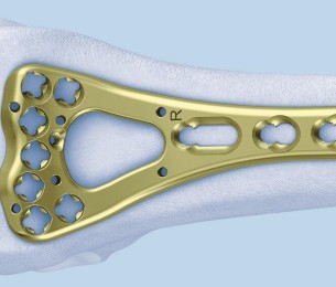 VA-LCP VOLAR RIM DISTAL DISTAL RADIUS PLATE