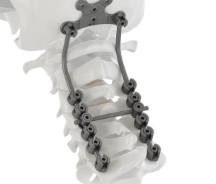 Vertex Occipital Fixation