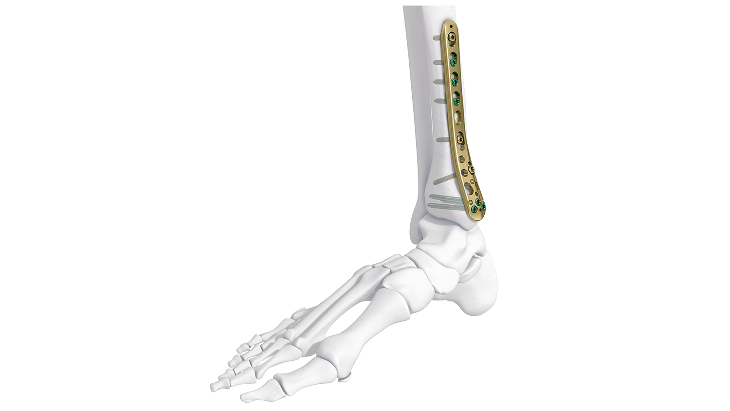 VA-LCP ANKLE PLATE